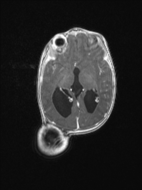 Chiari III malformation with occipital encephalocele (Radiopaedia 79446-92559 Axial T1 C+ mpr 49).jpg