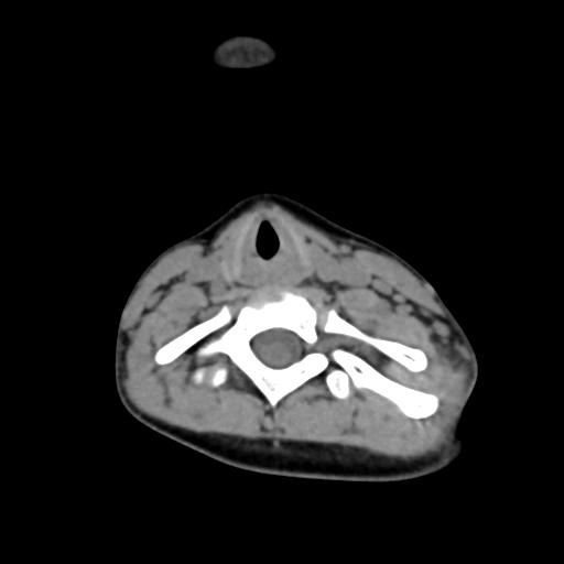 Chiari I with syrinx and skull base anomalies (Radiopaedia 89444-106412 Axial non-contrast 107).jpg