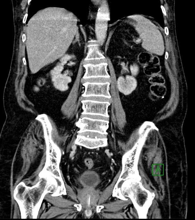 Cholangiocarcinoma with cerebral metastases (Radiopaedia 83519-98629 G 52).jpg