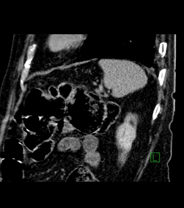 Cholangiocarcinoma with cerebral metastases (Radiopaedia 83519-98629 Sagittal C+ delayed 25).jpg
