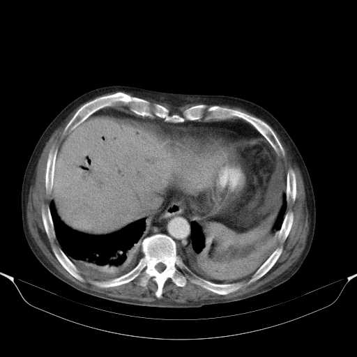 File:Cholangitis and abscess formation in a patient with cholangiocarcinoma (Radiopaedia 21194-21100 A 9).jpg