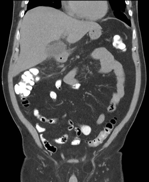 Cholecystitis with focal perforation and hepatic abscess (Radiopaedia 37189-38945 Coronal non-contrast 21).png
