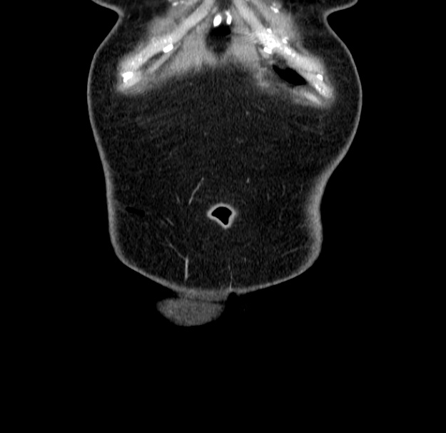 Choledocholithiasis on CT and MRI (Radiopaedia 24825-25087 C 2).jpg