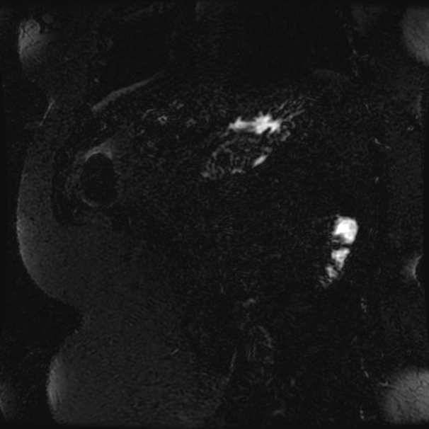 Choledocholithiasis on CT and MRI (Radiopaedia 24825-25088 Coronal T2 97).jpg