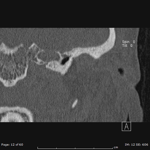 Cholesteatoma - external auditory canal (Radiopaedia 88452-105096 Coronal bone window 12).jpg