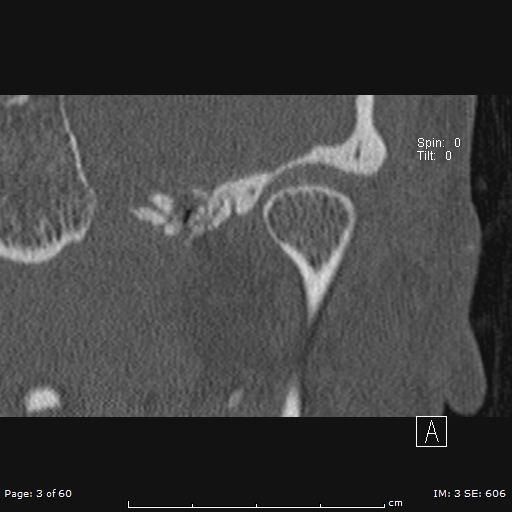 File:Cholesteatoma - external auditory canal (Radiopaedia 88452-105096 Coronal bone window 3).jpg