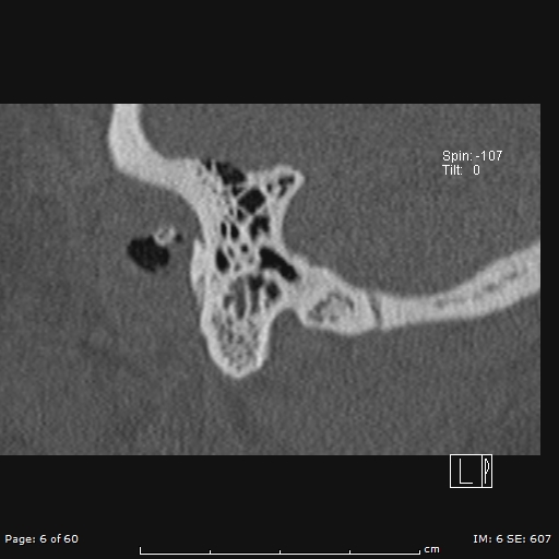 Cholesteatoma - external auditory canal (Radiopaedia 88452-105096 Sagittal bone window 6).jpg