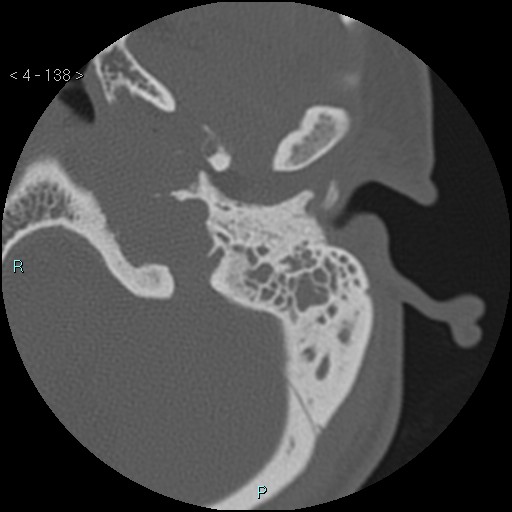 Cholesterol granuloma of the petrous apex (Radiopaedia 64358-73141 Axial bone window 67).jpg