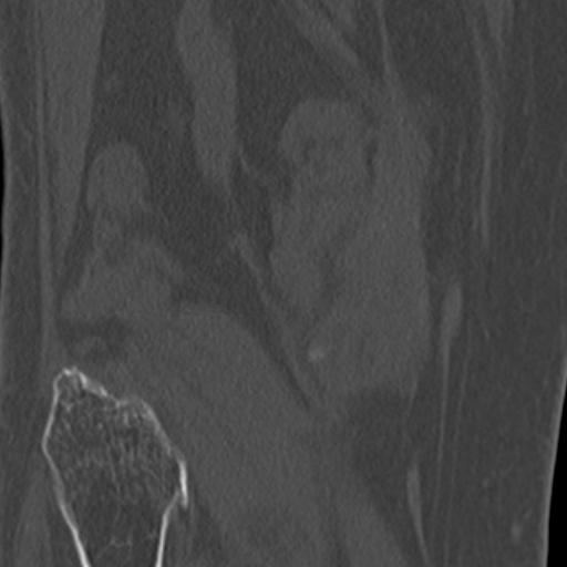Chondrocalcinosis (Radiopaedia 16275-15955 Coronal bone window 48).jpg