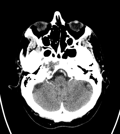 File:Chondrosarcoma of skull base- grade II (Radiopaedia 40948-43653 Axial Contrast 6).png