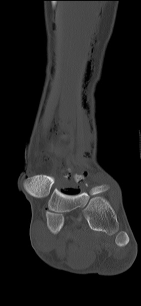 Chopart fracture (Radiopaedia 35347-36851 Coronal bone window 43).jpg