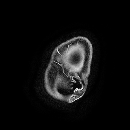 Chordoid glioma of third ventricle (Radiopaedia 91612-109340 F 200).jpg