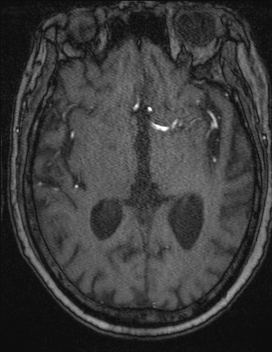 Choroid plexus xanthogranuloma - unilateral (Radiopaedia 85632-101393 Axial TOF 33).jpg