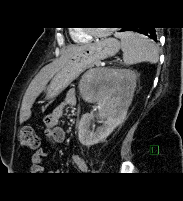 Chromophobe renal cell carcinoma (Radiopaedia 84239-99519 D 40).jpg