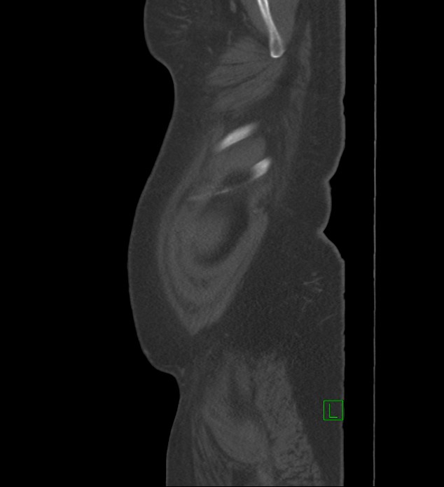 Chromophobe renal cell carcinoma (Radiopaedia 84239-99519 Sagittal bone window 102).jpg