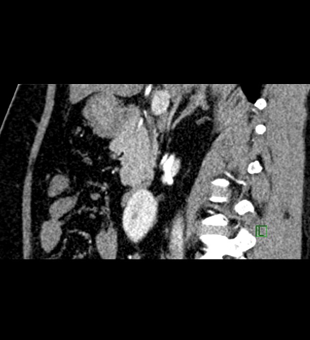 Chromophobe renal cell carcinoma (Radiopaedia 84286-99573 F 100).jpg