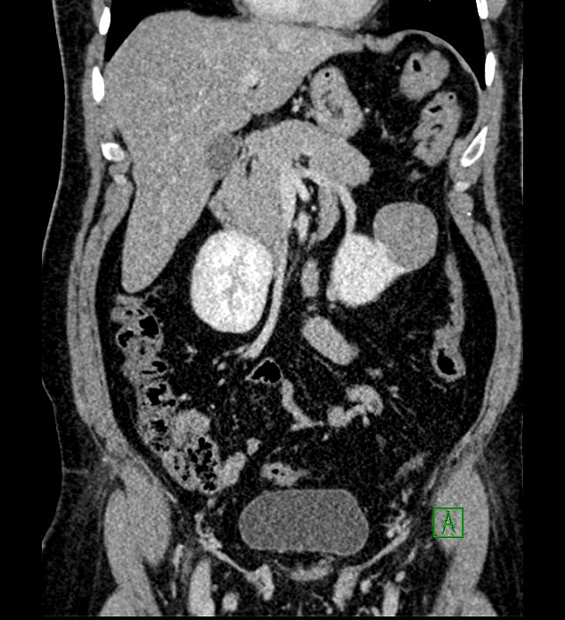 Chromophobe renal cell carcinoma (Radiopaedia 84286-99573 H 72).jpg