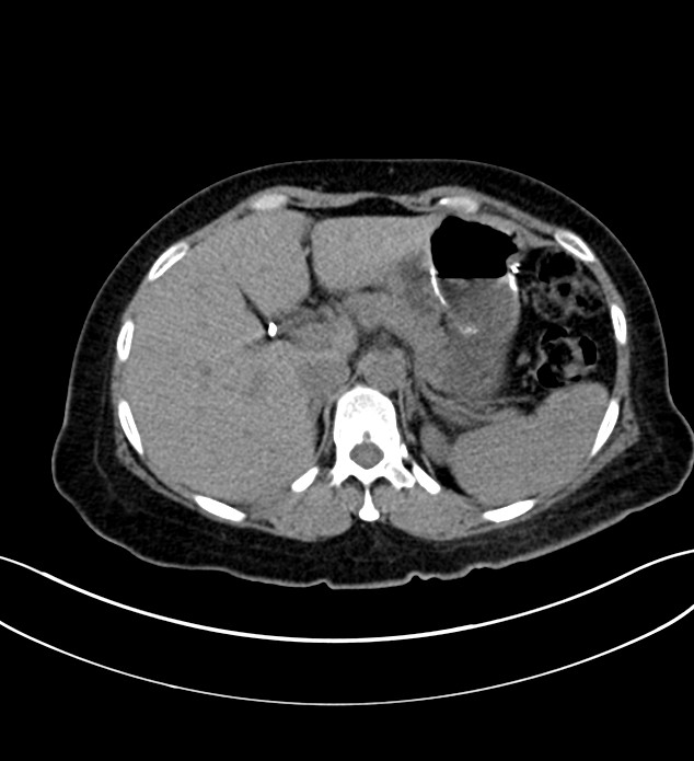 Chromophobe renal cell carcinoma (Radiopaedia 84290-99582 Axial non-contrast 37).jpg