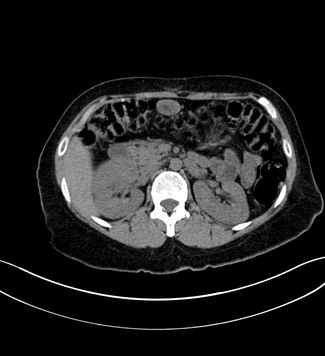 Chromophobe renal cell carcinoma (Radiopaedia 84290-99582 Axial non-contrast 53).jpg