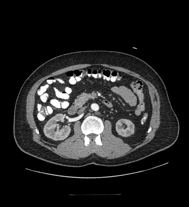 Chromophobe renal cell carcinoma (Radiopaedia 84337-99644 B 46).jpg