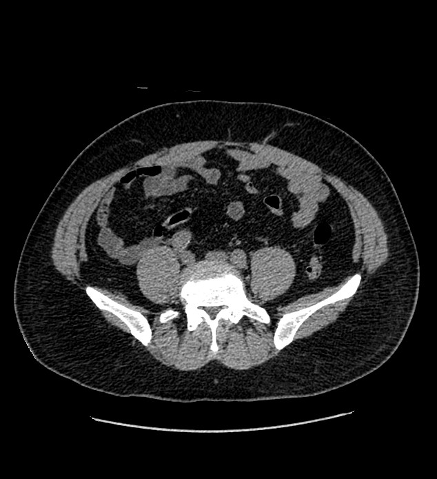 Chromophobe renal cell carcinoma (Radiopaedia 84337-99693 Axial non-contrast 104).jpg