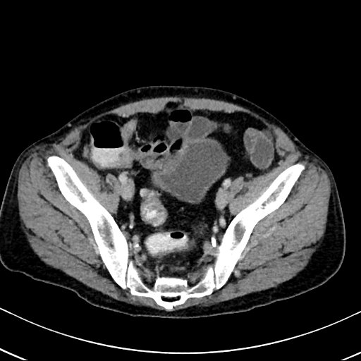 Chronic appendicitis complicated by appendicular abscess, pylephlebitis and liver abscess (Radiopaedia 54483-60700 B 120).jpg