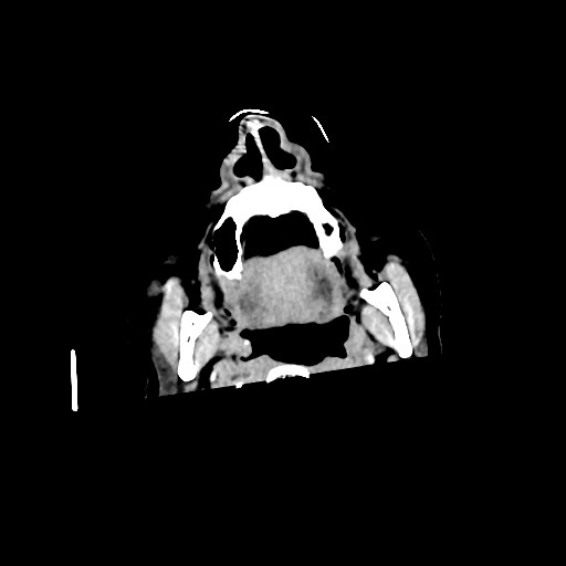 Chronic bilateral subdural hygroma (Radiopaedia 85801-101622 Axial non-contrast 10).jpg