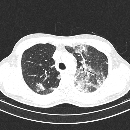 File:Chronic eosinophilic pneumonia (Radiopaedia 39331-41587 Axial lung window 16).png