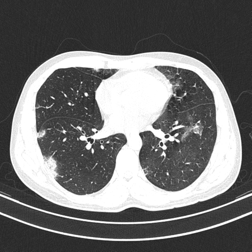 File:Chronic eosinophilic pneumonia (Radiopaedia 39331-41587 Axial lung window 32).png