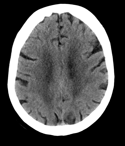 File:Chronic hypertensive encephalopathy (Radiopaedia 39993-42485 Axial non-contrast 23).png