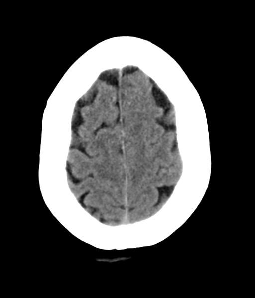 File:Chronic hypertensive encephalopathy (Radiopaedia 39993-42485 Axial non-contrast 28).png