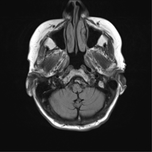 File:Chronic hypertensive encephalopathy (Radiopaedia 72844-83495 Axial FLAIR 3).png