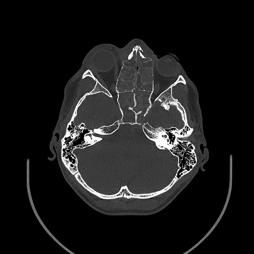 Chronic invasive fungal sinusitis (Radiopaedia 50342-55710 Axial bone window 71).jpg