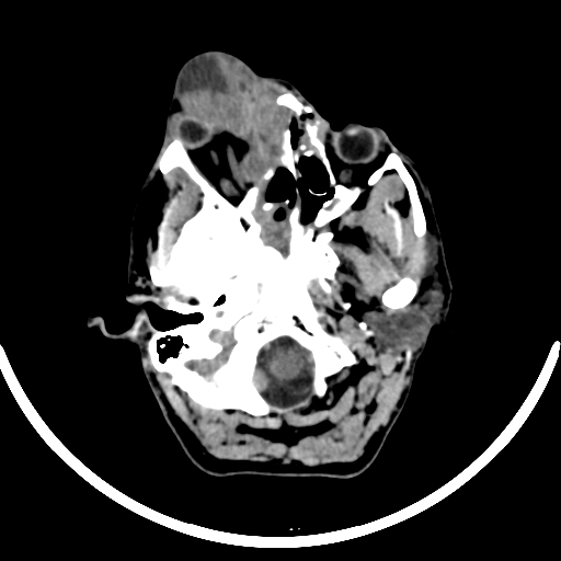 File:Chronic invasive fungal sinusitis with intraorbital and intracranial extension (Radiopaedia 56387-63046 Axial non-contrast 102).jpg