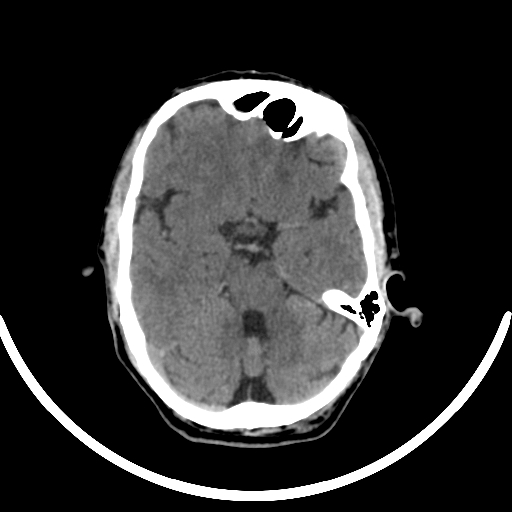 File:Chronic invasive fungal sinusitis with intraorbital and intracranial extension (Radiopaedia 56387-63046 Axial non-contrast 161).jpg