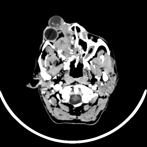 Chronic invasive fungal sinusitis with intraorbital and intracranial extension (Radiopaedia 56387-63046 B 58).jpg