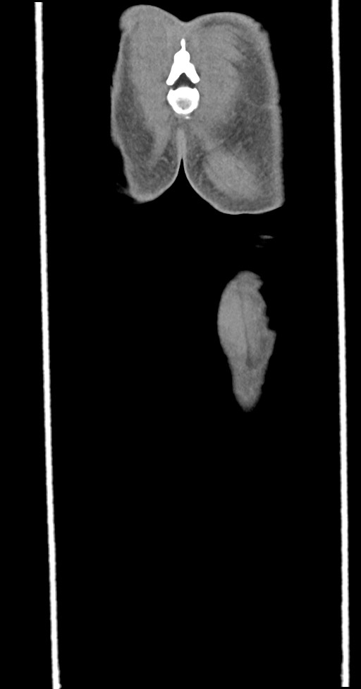 Chronic osteomyelitis (with sequestrum) (Radiopaedia 74813-85822 E 56).jpg