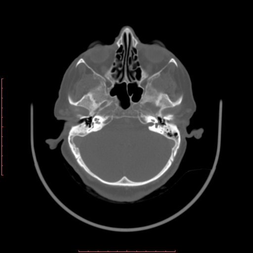 Chronic osteomyelitis - maxilla (Radiopaedia 23783-23927 Axial bone window 123).jpg