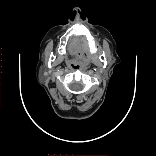 File:Chronic osteomyelitis - maxilla (Radiopaedia 23783-23927 B 63).jpg