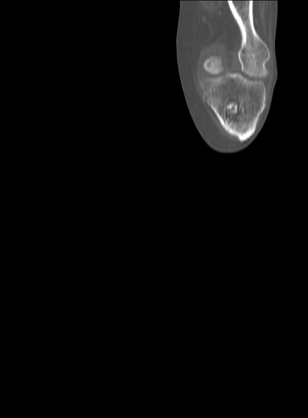 Chronic osteomyelitis - tibia (with sequestrum) (Radiopaedia 73273-84090 Coronal non-contrast 13).jpg