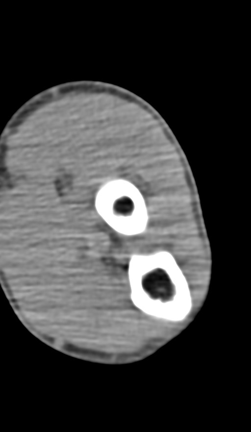 Chronic osteomyelitis of the distal humerus (Radiopaedia 78351-90971 Axial non-contrast 111).jpg