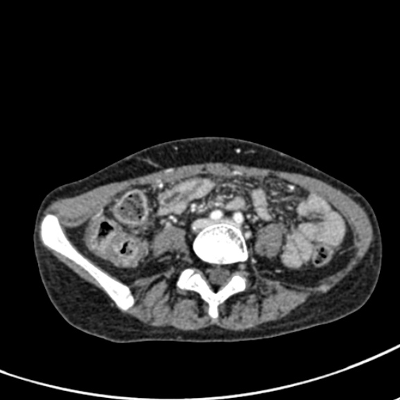 Chronic pancreatitis (Radiopaedia 55405-61846 A 67).jpg