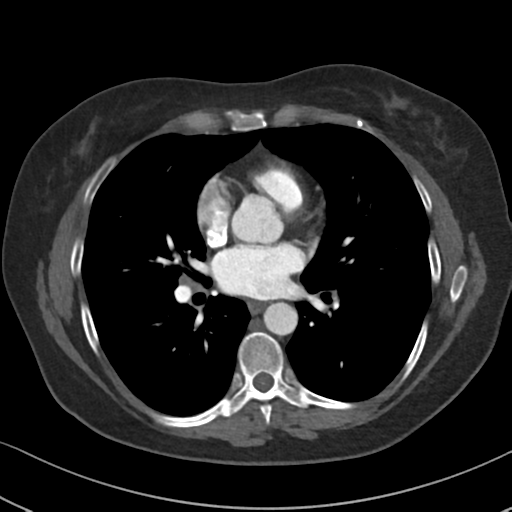 Chronic pulmonary embolus (Radiopaedia 39129-41341 Axial C+ CTPA 58).png