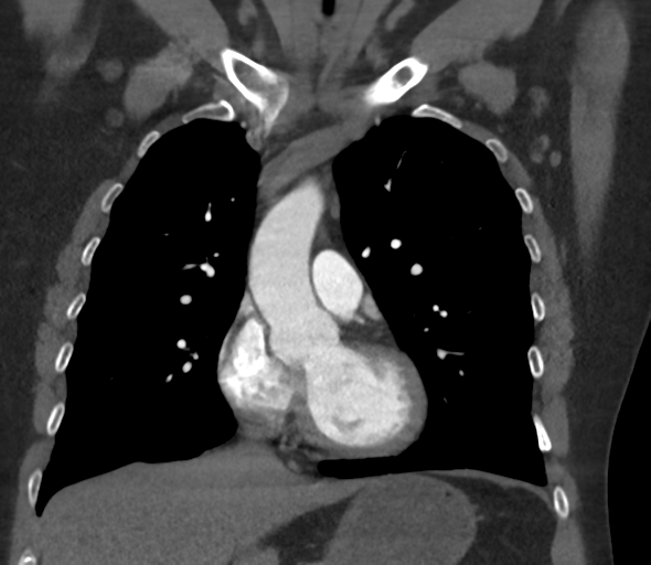 File:Chronic pulmonary embolus (Radiopaedia 39129-41341 Coronal C+ CTPA 36).png