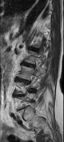 File:Chronic spinal hematoma with cauda equina syndrome (Radiopaedia 75745-87090 Sagittal T2 2).png