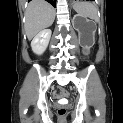File:Chronic ureteropelvic junction obstruction (Radiopaedia 78365-90996 B 72).jpg