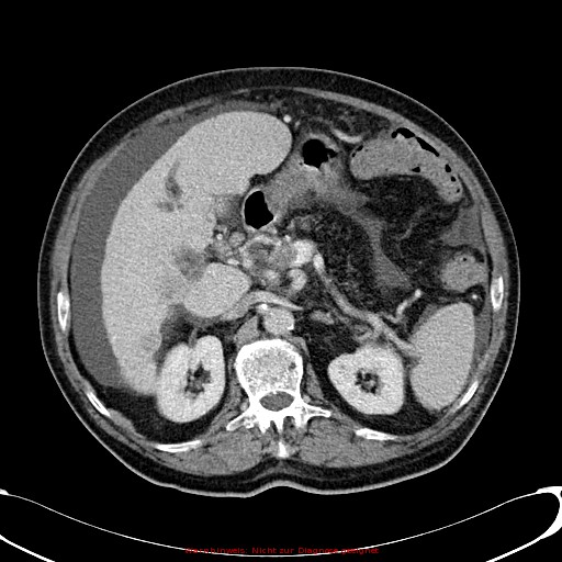 Cirrhosis and hepatocellular carcinoma in the setting of hemochromatosis (Radiopaedia 75394-86595 B 34).jpg