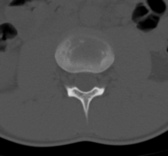 Clear cell meningoma - lumbar spine (Radiopaedia 60116-67691 Axial bone window 30).png