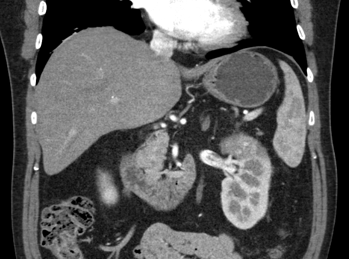 File:Clear cell renal cell carcinoma (Radiopaedia 61449-69393 C 9).jpg