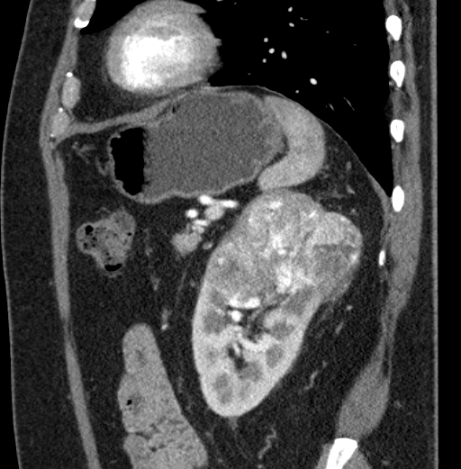 File:Clear cell renal cell carcinoma (Radiopaedia 61449-69393 D 22).jpg